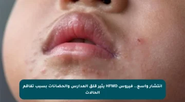 انتشار واسع.. فيروس HFMD يثير قلق المدارس والحضانات بسبب تفاقم الحالات